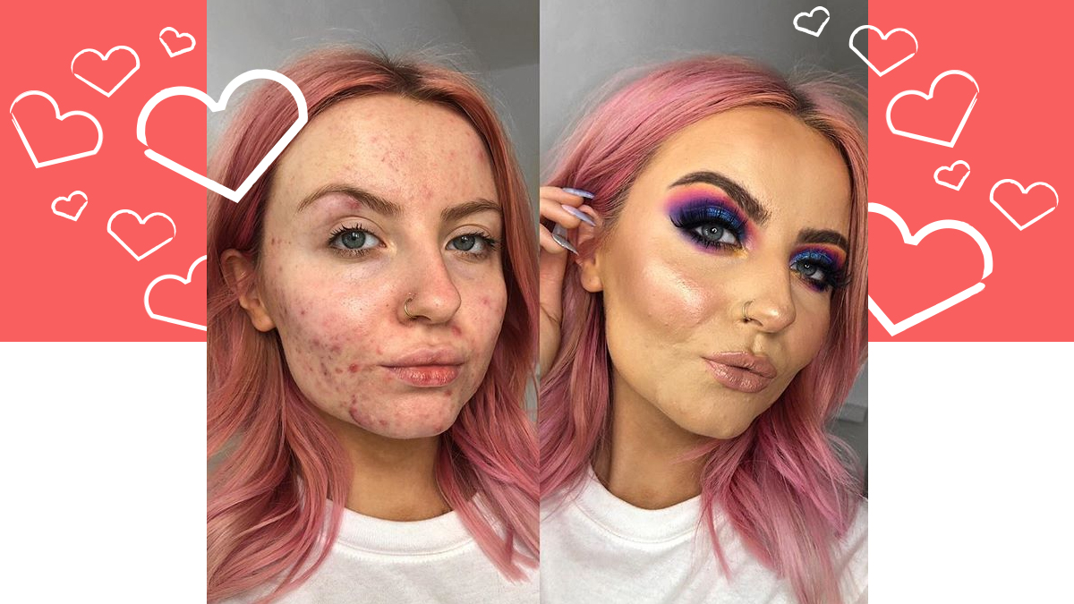 Abbie Bull’s Acne Positivity Will Inspire You To Embrace Your Skin