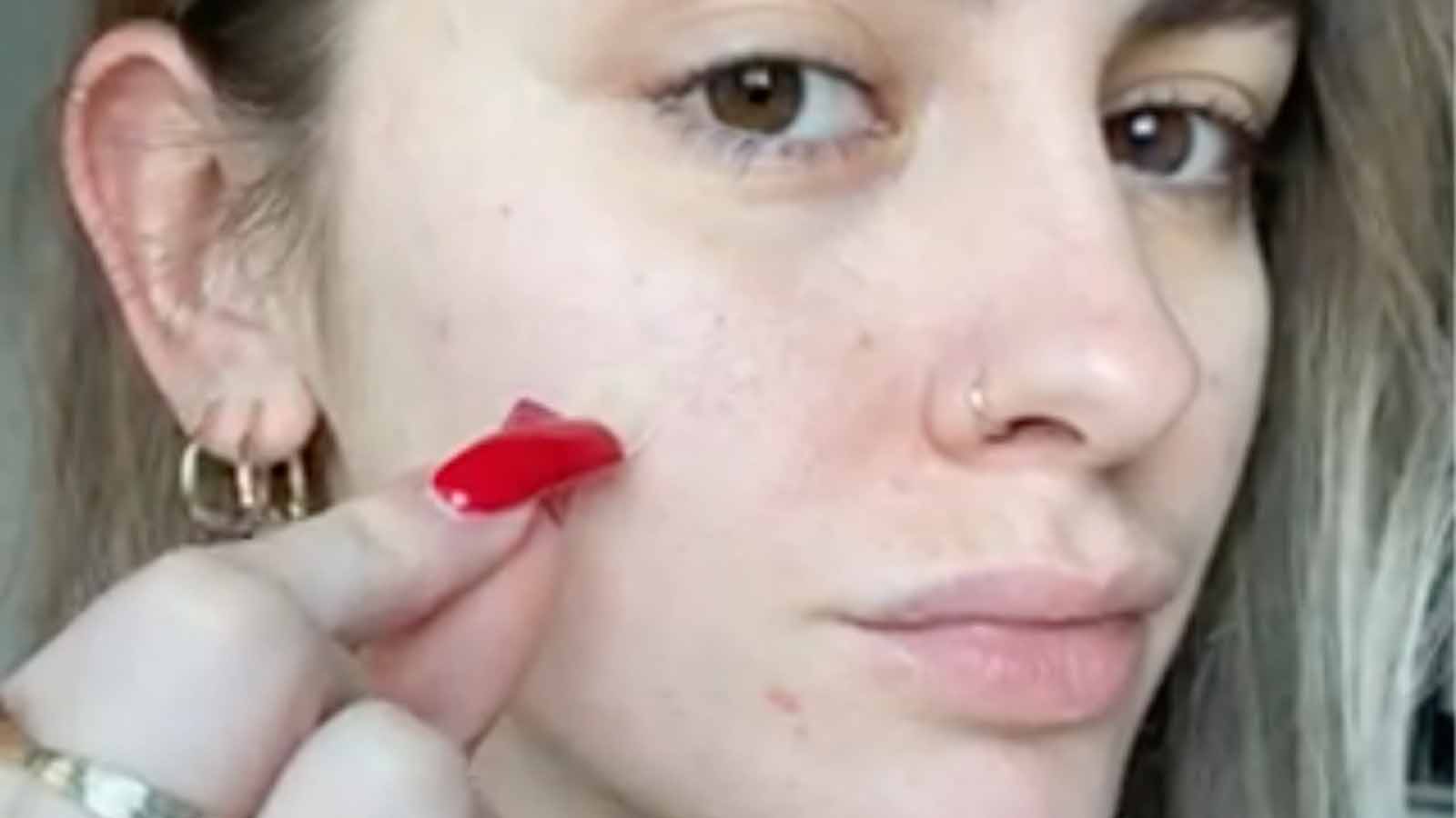 How To Get Rid Of Spots Overnight