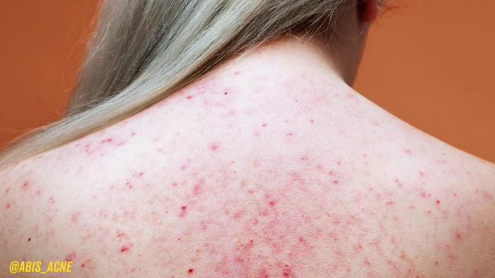 Ask Grace: How Can I Clear My Bacne?