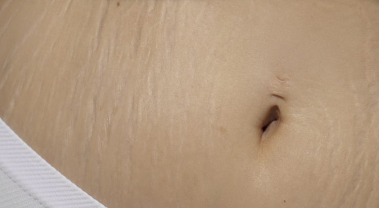 Ask Grace: Why Do I Get Stretch Marks?