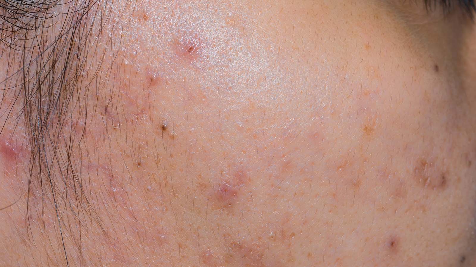 Ask Grace: How Can I Fade The Red Marks That Breakouts Leave Behind?